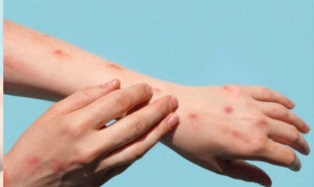 سرعت جهش ژنی «آبله میمونی ۱b»/ تفاوت این بیماری با کرونا